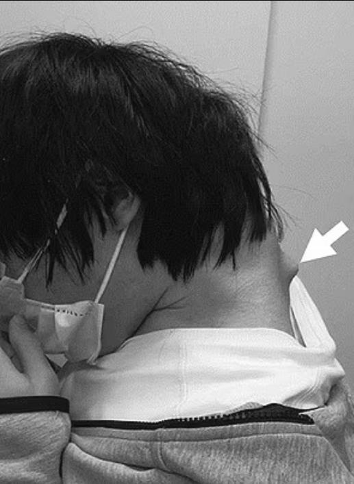 إصابة شاب بمتلازمة الرأس المتدلي بسبب الجوال