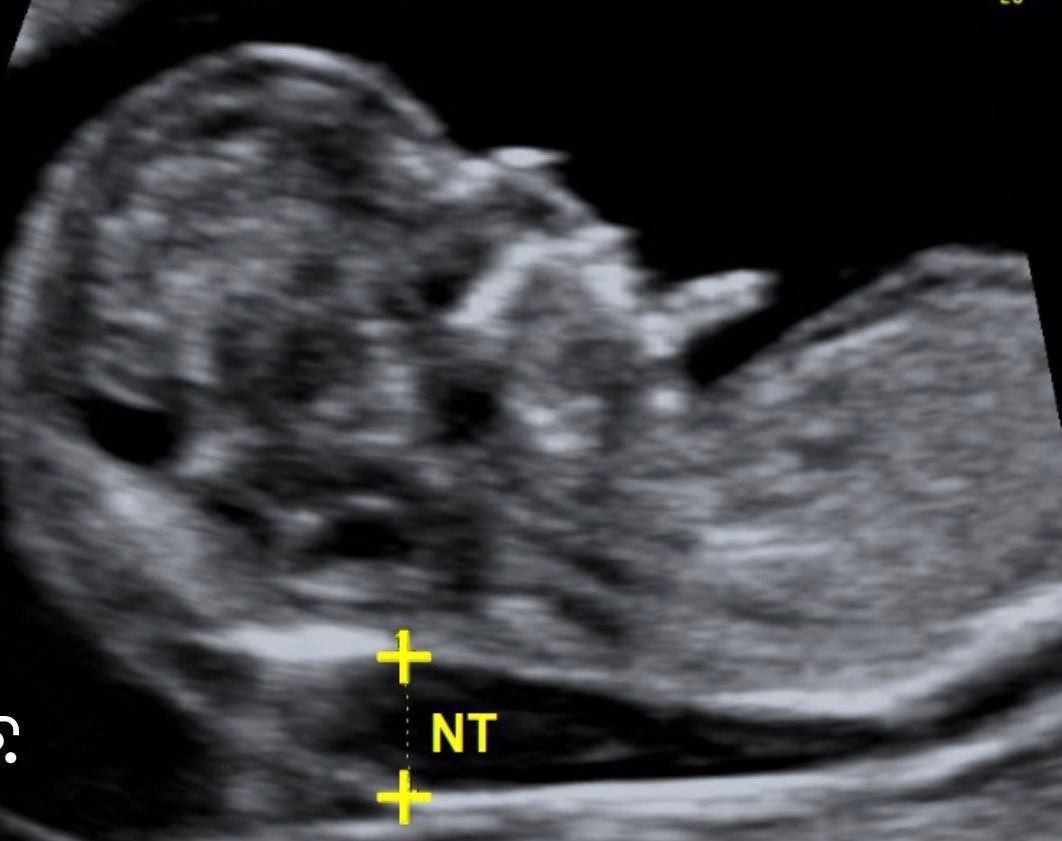 مها النمر: فحوصات ما قبل نفخ الروح تعطي تشخيص دقيق لسلامة الجنين