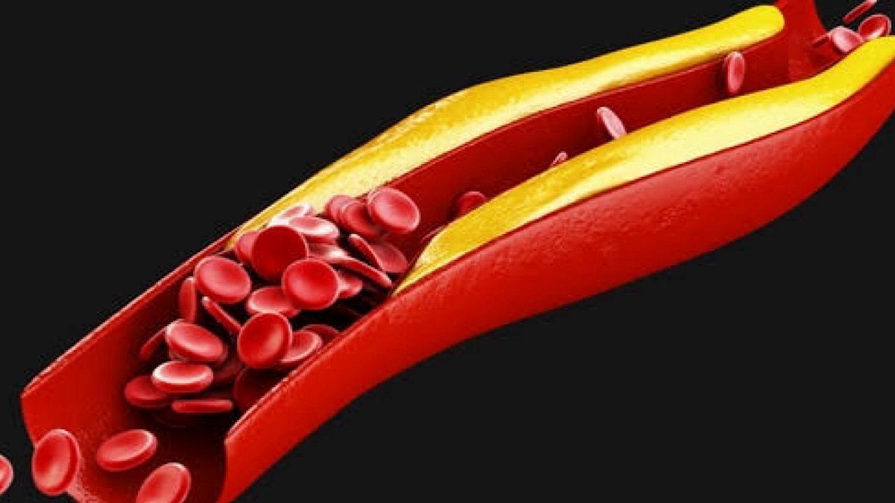 النمر: ارتفاع الكوليسترول النافع لا يلغي خطر الكوليسترول الضار المسبب للجلطات