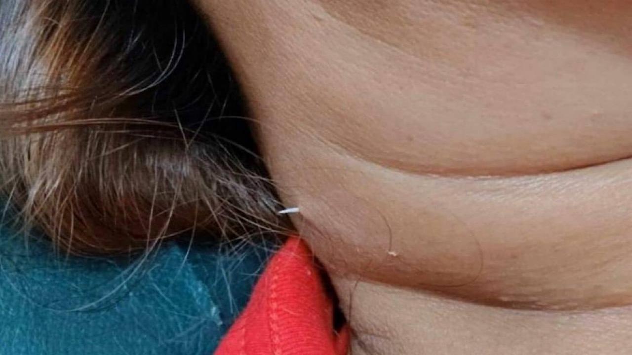 شوكة بطول 2 سم تعلق وتخترق حلق سيدة بعد تناول وجبة سمك.. صور