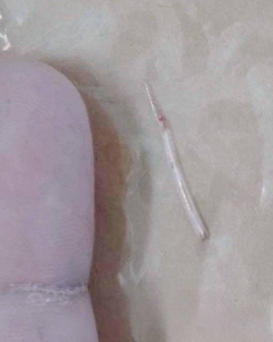 شوكة بطول 2 سم تعلق وتخترق حلق سيدة بعد تناول وجبة سمك.. صور