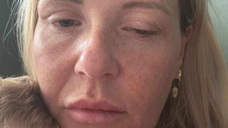 حقن تجميل غير مرخصة تصيب النساء بالتسمم في بريطانيا