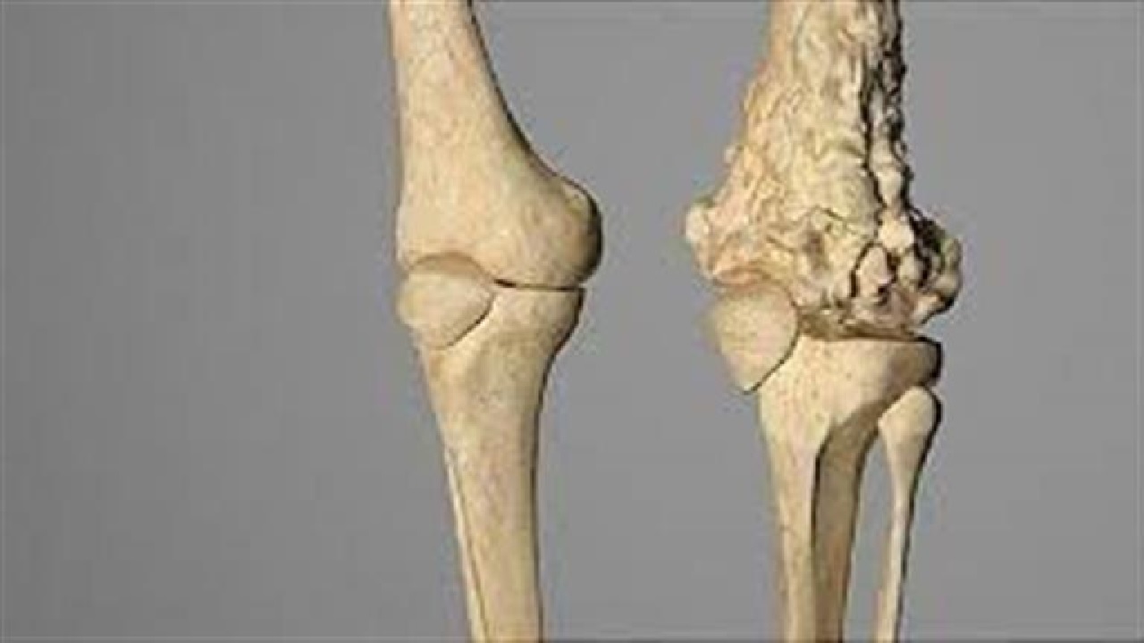 هشام العبد اللطيف: الشفاء من سرطان العظام يتجاوز 70٪ مع الكشف المبكر .. فيديو