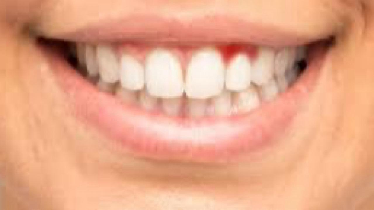 طبيب: اهمال نظافة الفم تزيد من مخاطر حدوث النوبات القلبية