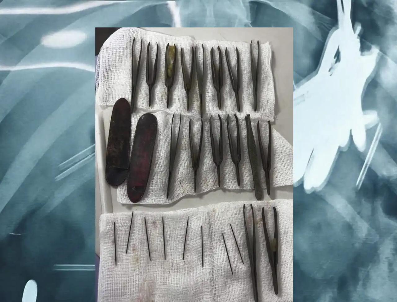 شاب يبتلع 24 ملقط شعر وإبرة.. صور