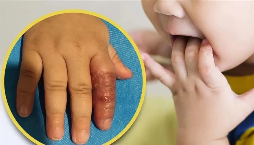 أم كادت تتسبب في بتر إصبع رضيعتها بسبب نصيحة على الانترنت