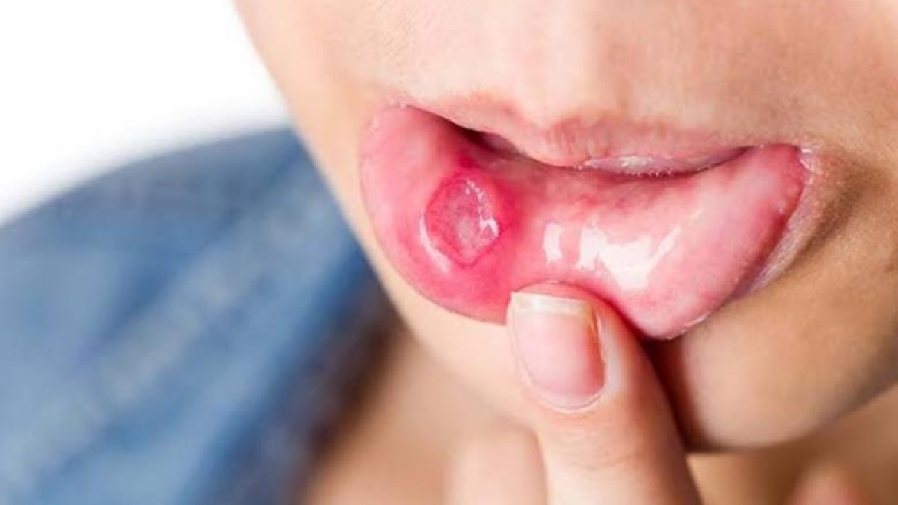 أعراض تشير للإصابة بمرض بهجت وتقرحات تسبب فقدان البصر .. فيديو