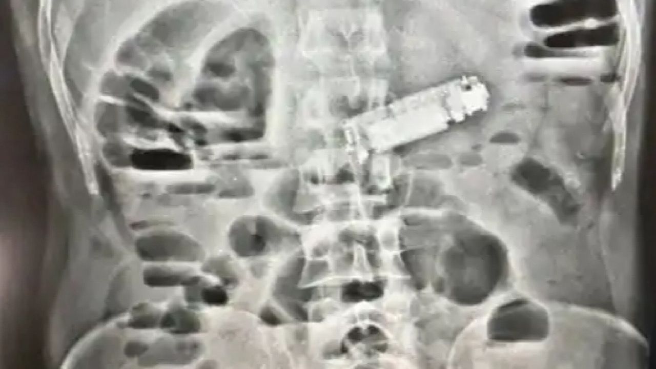  نجاح جراحة طارئة لاستخراج هاتف من معدة مريض