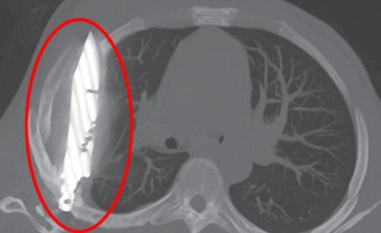 استخراج سكين علق بصدر شاب 8 أعوام