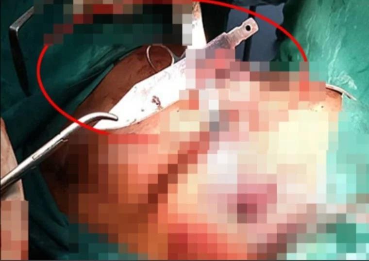 استخراج سكين علق بصدر شاب 8 أعوام