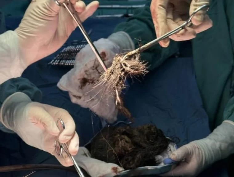 استخراج كرة شعر وزنها 2 كيلوغرام من معدة فتاة .. صورة