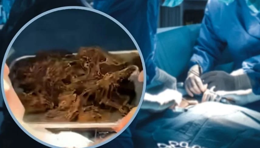 استخراج كرة شعر وزنها 2 كيلوغرام من معدة فتاة .. صورة