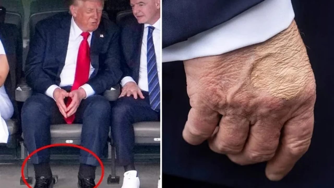 علامات على جسد ترامب تكشف مرضاً خطيراً يهدد أطرافه بالبتر ..صور