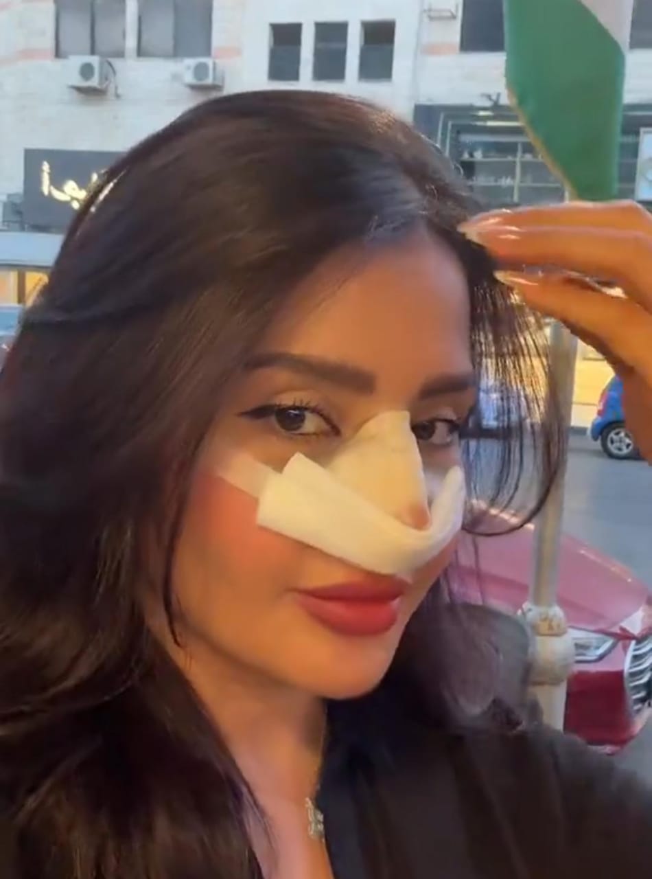 بدور البراهيم تثير الجدل بعد عملية تجميل أنف جديدة .. فيديو