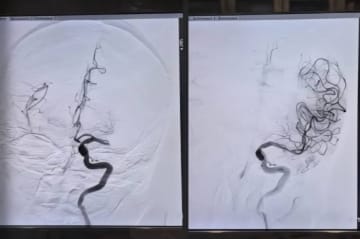 بوقت قياسي.. فريق مسار السكتات الدماغية ينقذ حياة مريضة