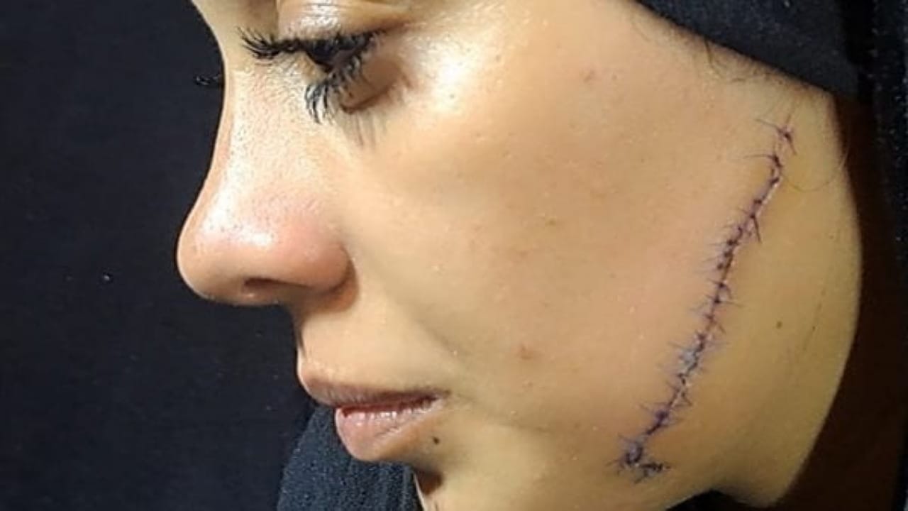 تفاصيل صادمة.. طليقة تشوه وجه عروس بـ 41 غرزة قبل زفافها