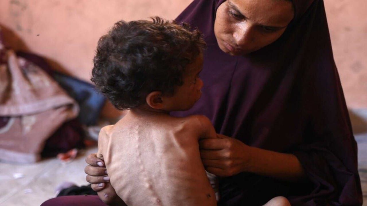 فيروس قاتل يشبه كورونا يهدد حياة الأطفال الجوعى في غزة