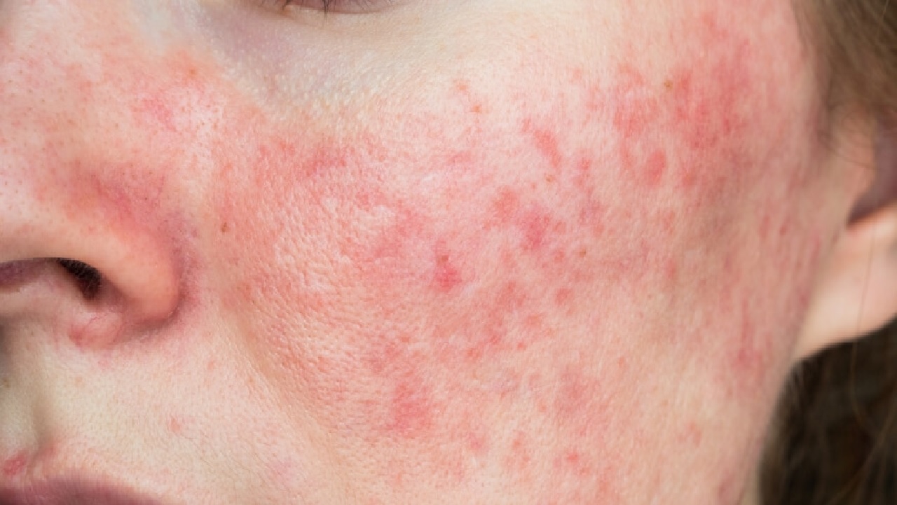 نصائح للعناية بالبشرة الحساسة والحد من مشاكل الوردية
