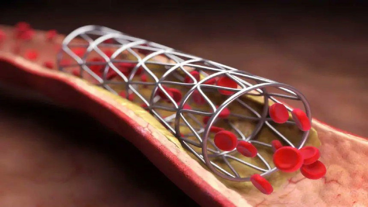 النمر : الدعامة داخل الشريان التاجي ليست علاجًا للمرض نفسه