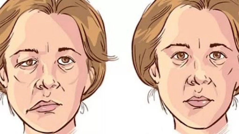 استشاري يوضح الفرق بين شلل العصب السابع والجلطة الدماغية .. فيديو