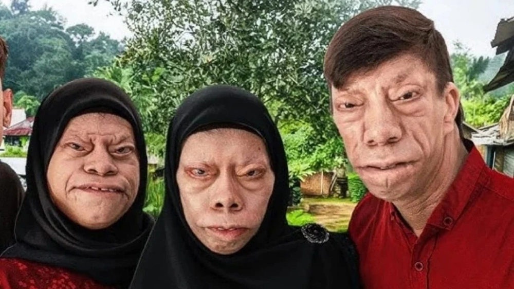 عائلة إندونيسية تكسب شهرة عالمية بعد مشاركة حياتها مع متلازمة نادرة .. فيديو