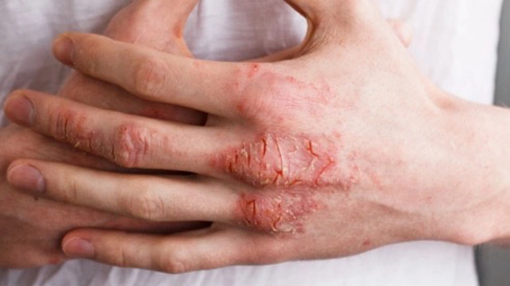 برودة الشتاء تثير نوبات الإكزيما وتزيد معاناة البشرة الجافة