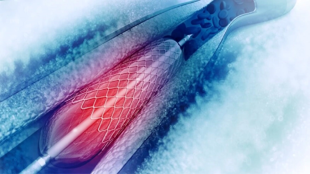 النمر: توقف الأدوية بعد تركيب الدعامة يسبب جلطات حادة