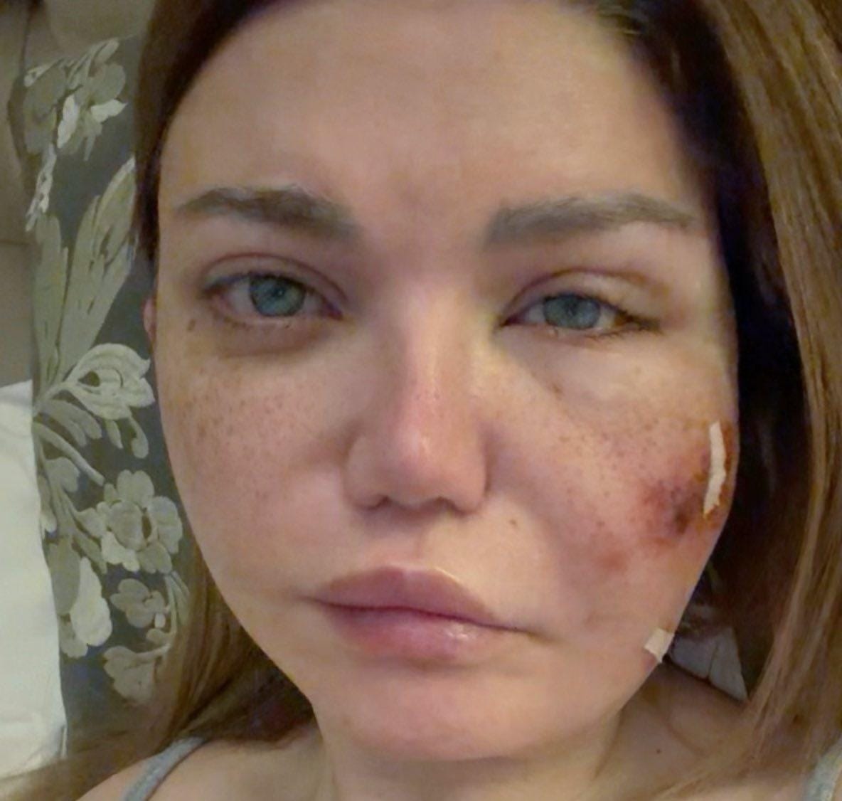 إصابة ياسمين الخطيب بعدوى بكتيرية في أنسجة بشرة الوجه.. صور