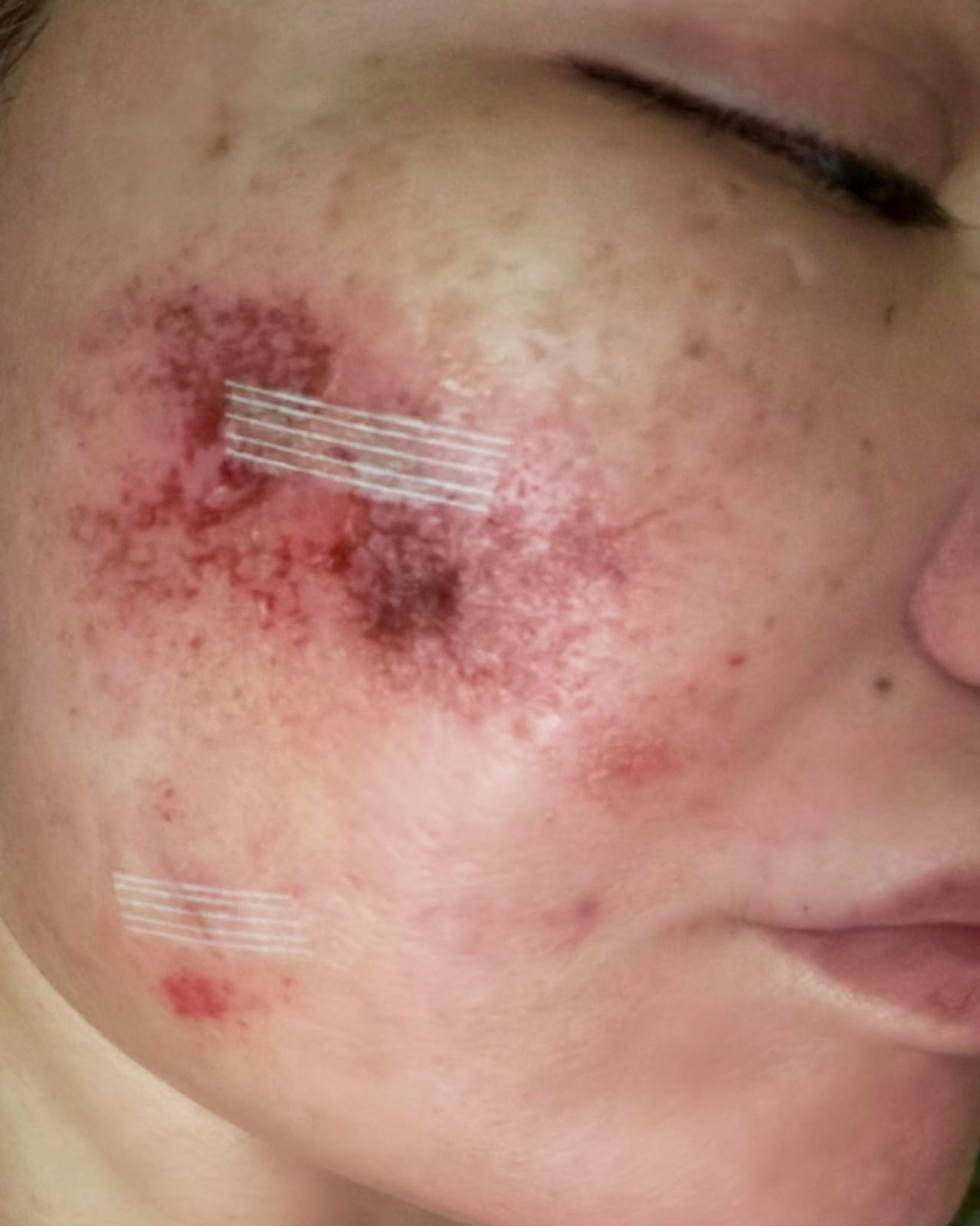 إصابة ياسمين الخطيب بعدوى بكتيرية في أنسجة بشرة الوجه.. صور