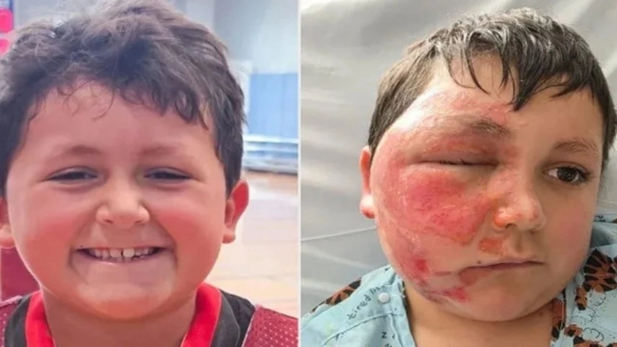 إصابة طفل بحروق خطيرة بسبب تحدي على تيك توك .. صور