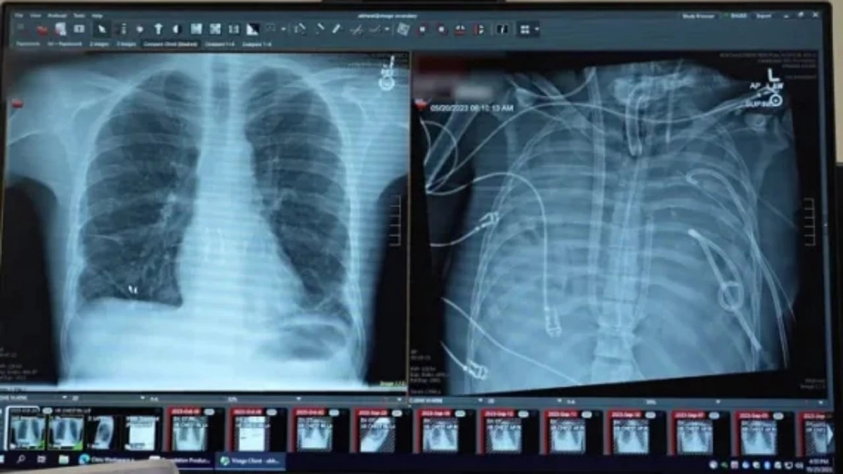 إنجاز غير مسبوق .. شاب يعيش لمدة 48 ساعة بلا رئتين وينجو من الموت