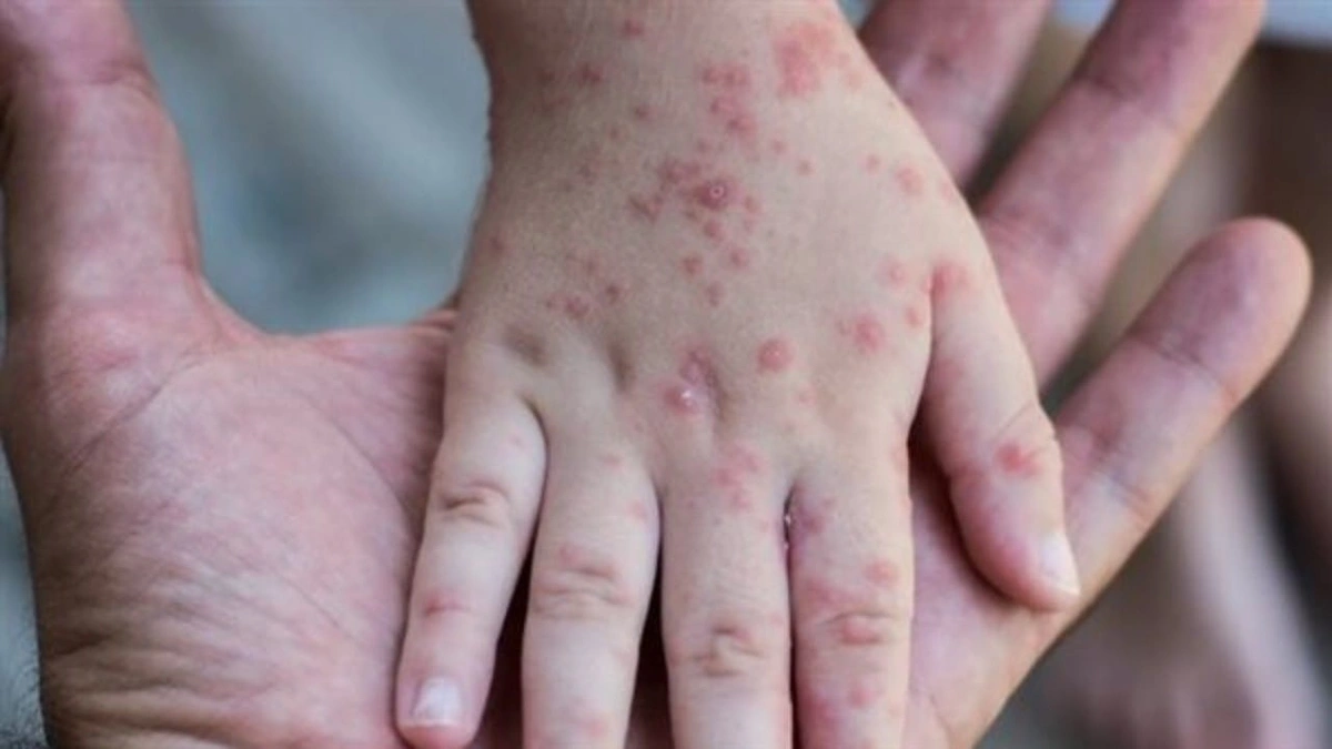 إطلاق إنذار وبائي بعد تفشي الحصبة