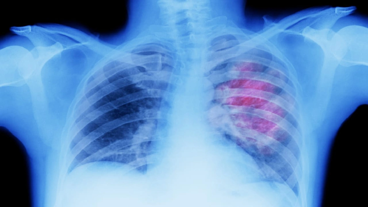 علامة خفية في أصابعك تنذر بسرطان الرئة