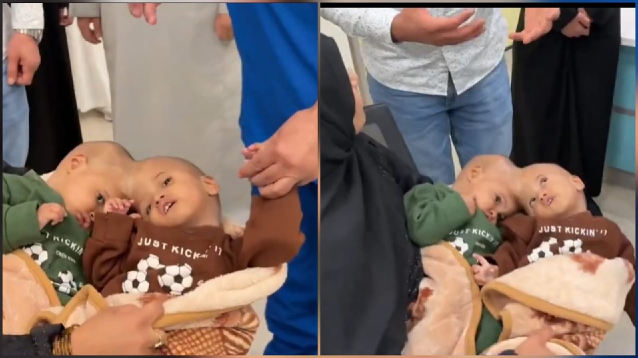 وصول التوأم السيامي الباكستاني سفيان ويوسف إلى الرياض.. فيديو