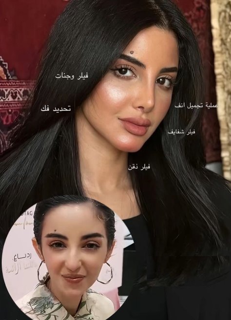 لقطات تكشف ملامح لمى الكناني قبل وبعد عمليات التجميل.. صور