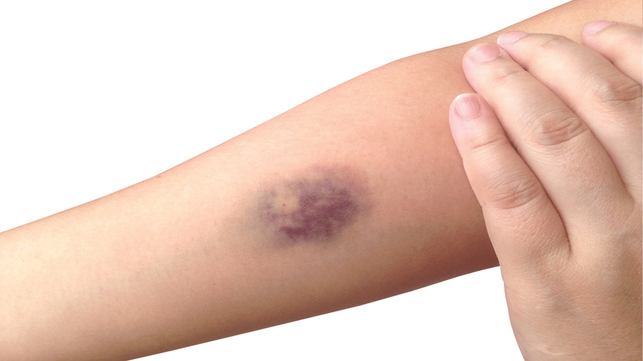 أسباب تؤدي لظهور الكدمات بشكل مفاجئ في الجسم.. فيديو