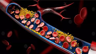 دراسة: الكوليسترول لا يقتصر على الأشخاص الذين يعانون من زيادة الوزن