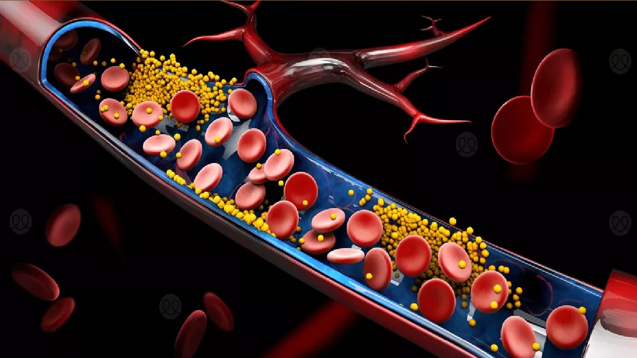 دراسة: الكوليسترول لا يقتصر على الأشخاص الذين يعانون من زيادة الوزن