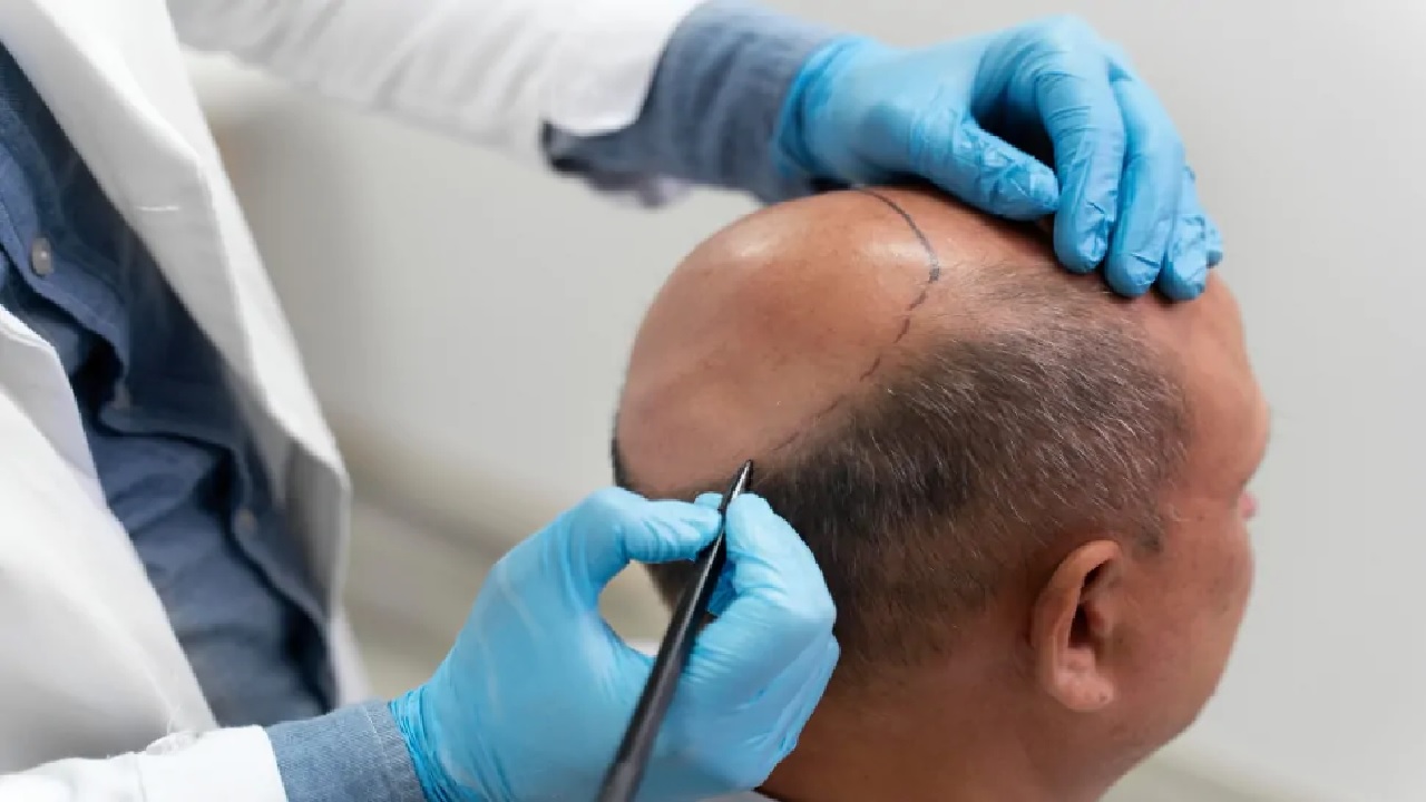 الصحة تشدد الرقابة على مراكز زراعة الشعر وتفرض عقوبات صارمة