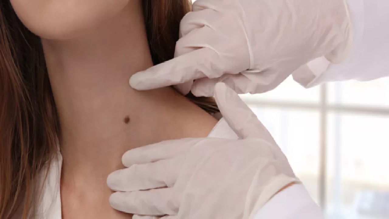 استشاري: التعرض للشمس يزيد مخاطر الشامات بشكل تراكمي.. فيديو