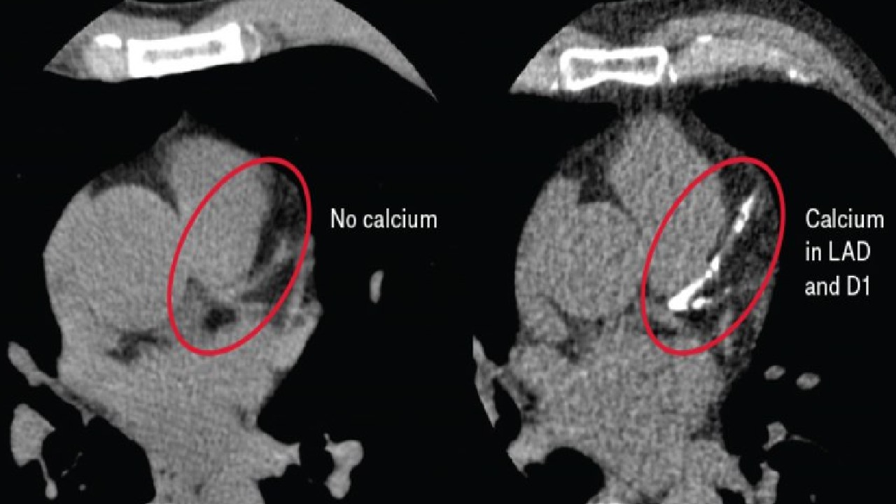 النمر: وجود التكلّس في الشرايين التاجية لا يعني وجود تضيق مُعيق للتدفق