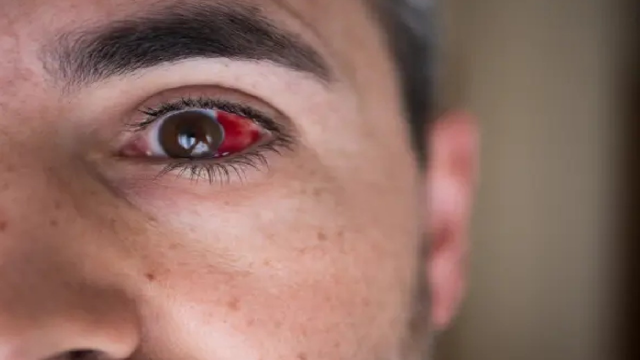 النمر: أول علامة على ضرر الضغط فقداناً مفاجئاً للبصر