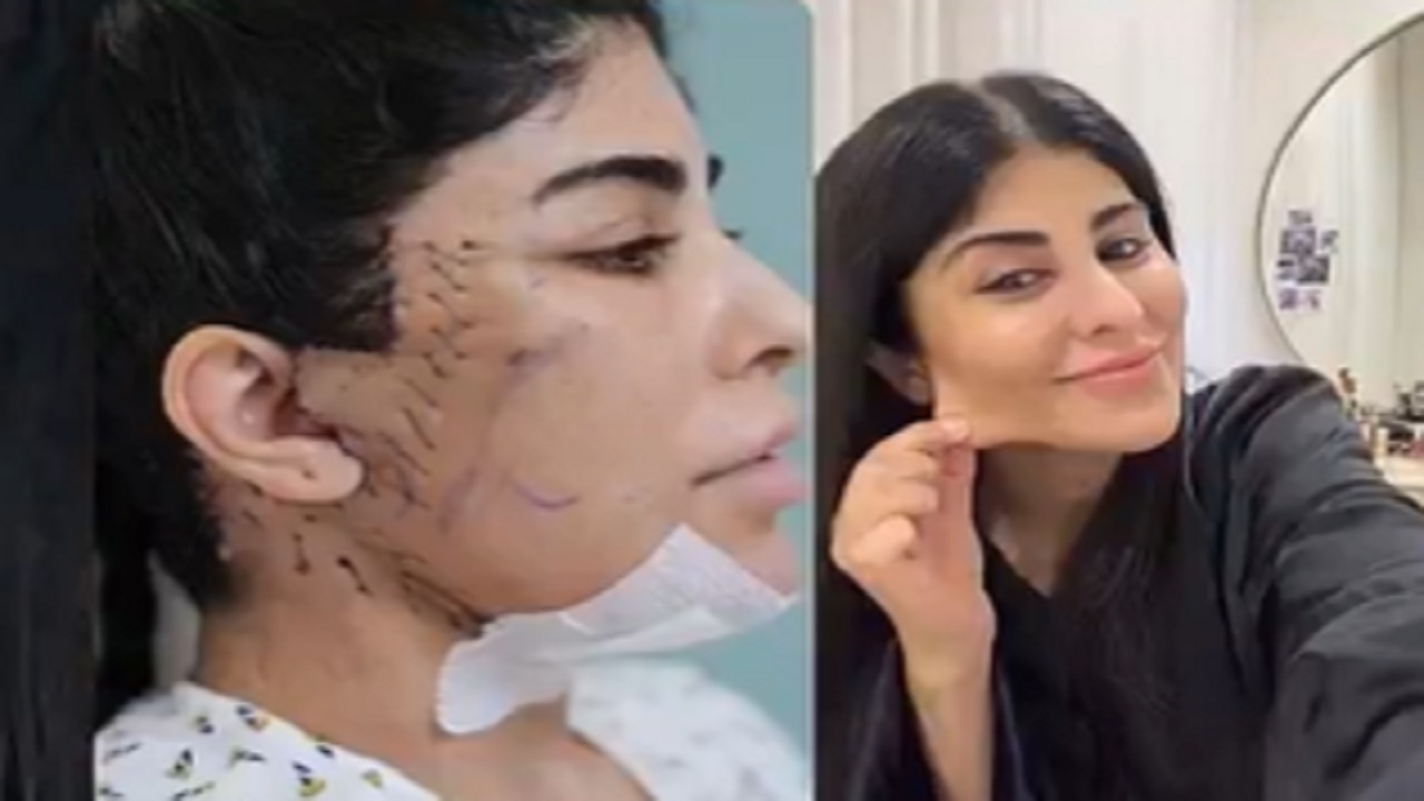 زارا البلوشي توثق نتيجة عملية شد الوجة بعد مرور 5 أشهر .. فيديو
