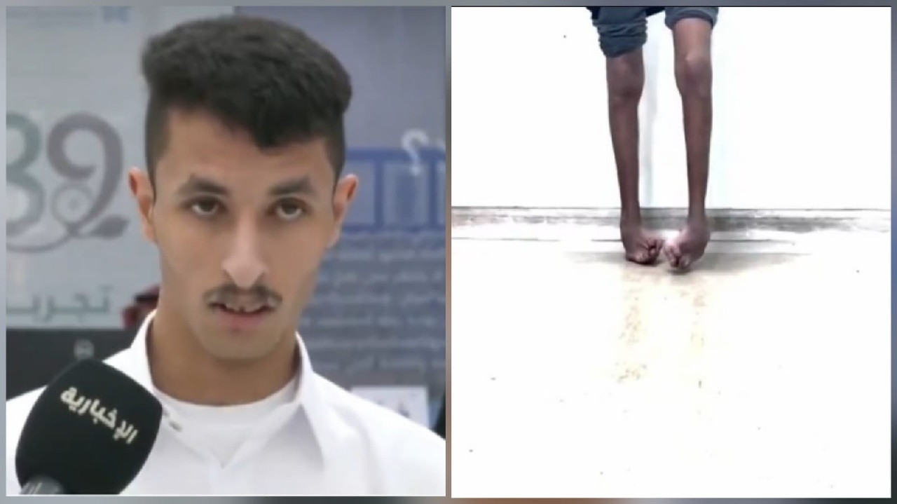 فيصل الحازمي يعود للمشي بعد 17 عامًا من المعاناة مع القدم الحنفاء .. فيديو