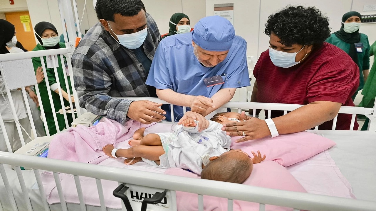 بدء عملية فصل التوأم الملتصق الفيجي “جسبيلي وديسيسيا” بالرياض