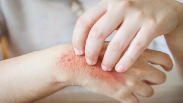 استشاري: 30 % من أفراد المجتمع معرضون للإصابة للحزام الناري.. فيديو
