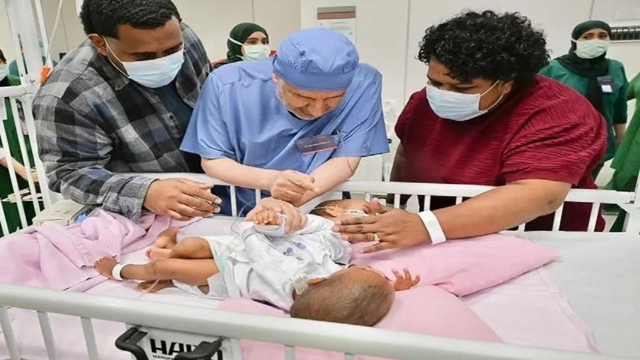 نجاح عملية فصل التوأم الملتصق الفيجي “جسبيلي وديسيسيا” بعد 12 ساعة و45 دقيقة