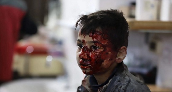 صورة مؤثرة لطفل سوري جريح في الغوطة الشرقية