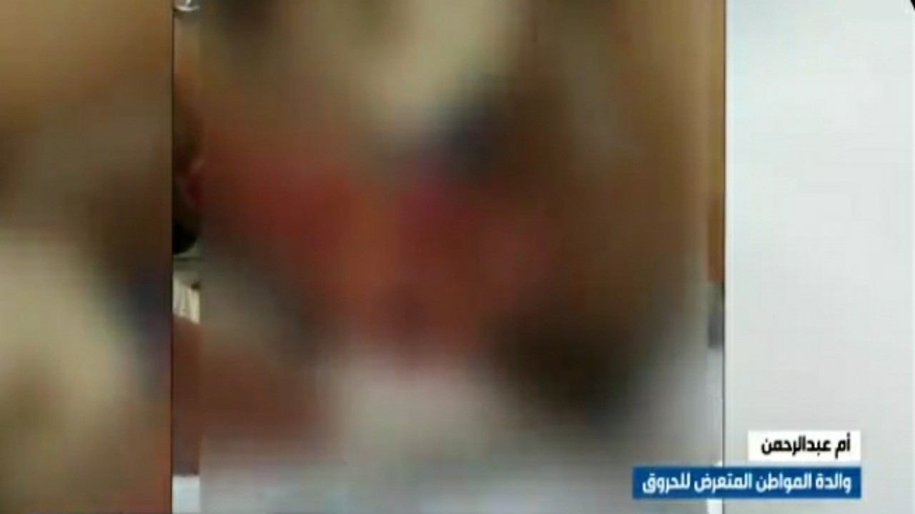 بالفيديو.. والدة المواطن المتعرض للحروق: مركز الإيواء تأخر في إسعاف &#8220;ابني&#8221;