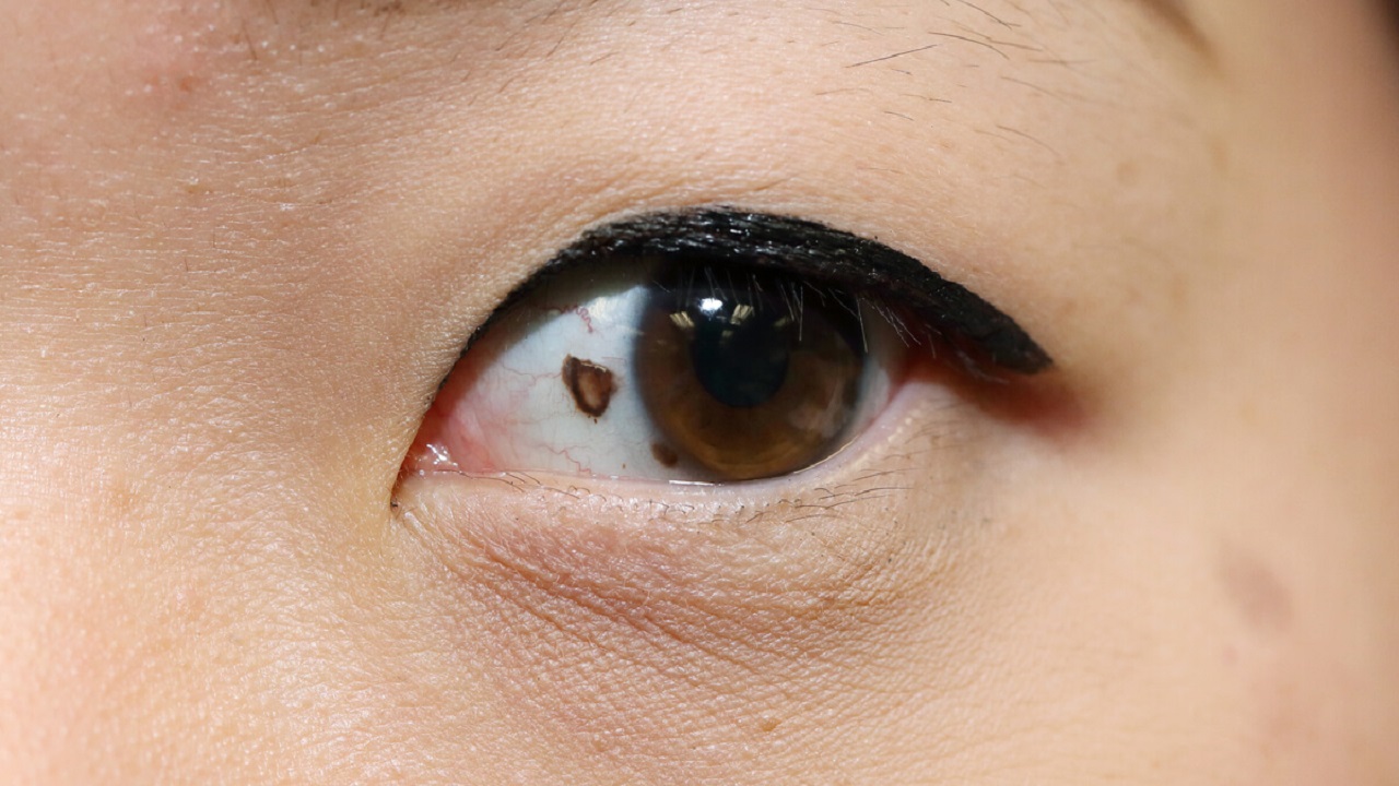 علامات تشير إلى الإصابة بسرطان العين